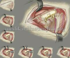 Spinal Cerrahi [Anatomi çizimi]